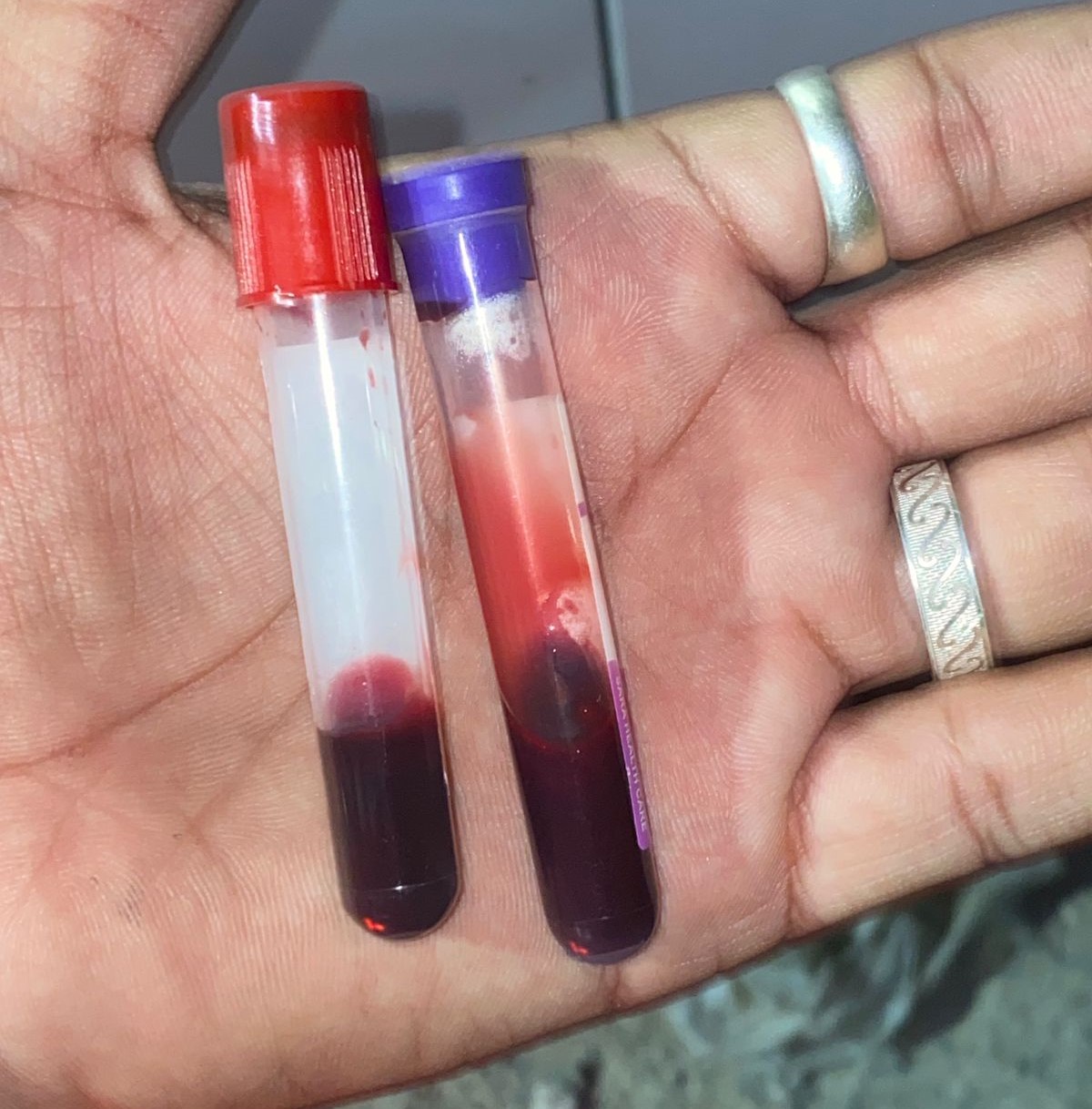 दलाल ने विश्वास दिलाने के लिए ब्लड सैंपल की फोटो भी वॉट्सऐप की।